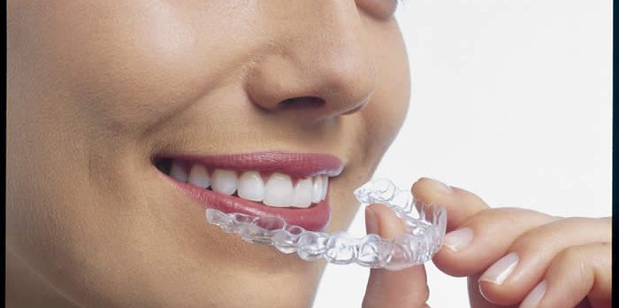 invisalign dentist